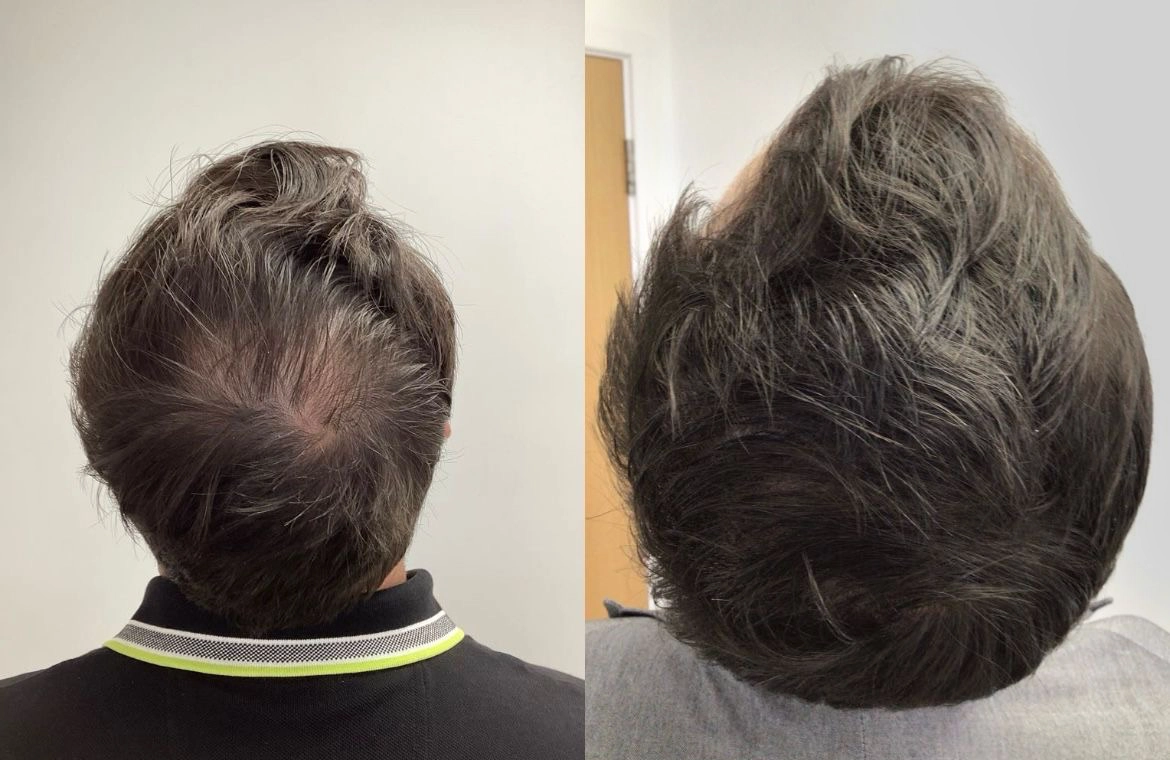 PRP Hair Treatment in Malaysia: All You Need to Know 4 prp-treatment-result