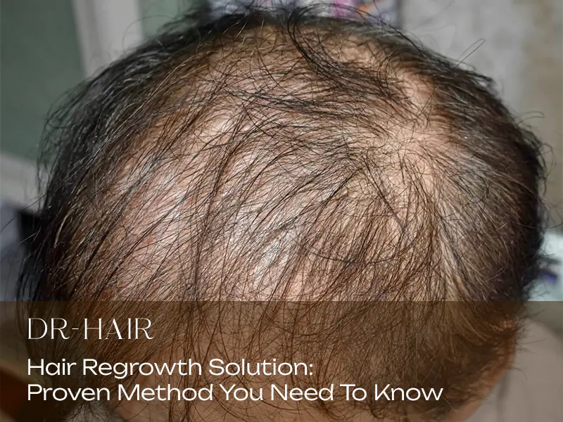 Proven Hair Regrowth Solution in Malaysia For Thinning Hair 6 effective and proven hair regrowth solution malaysia