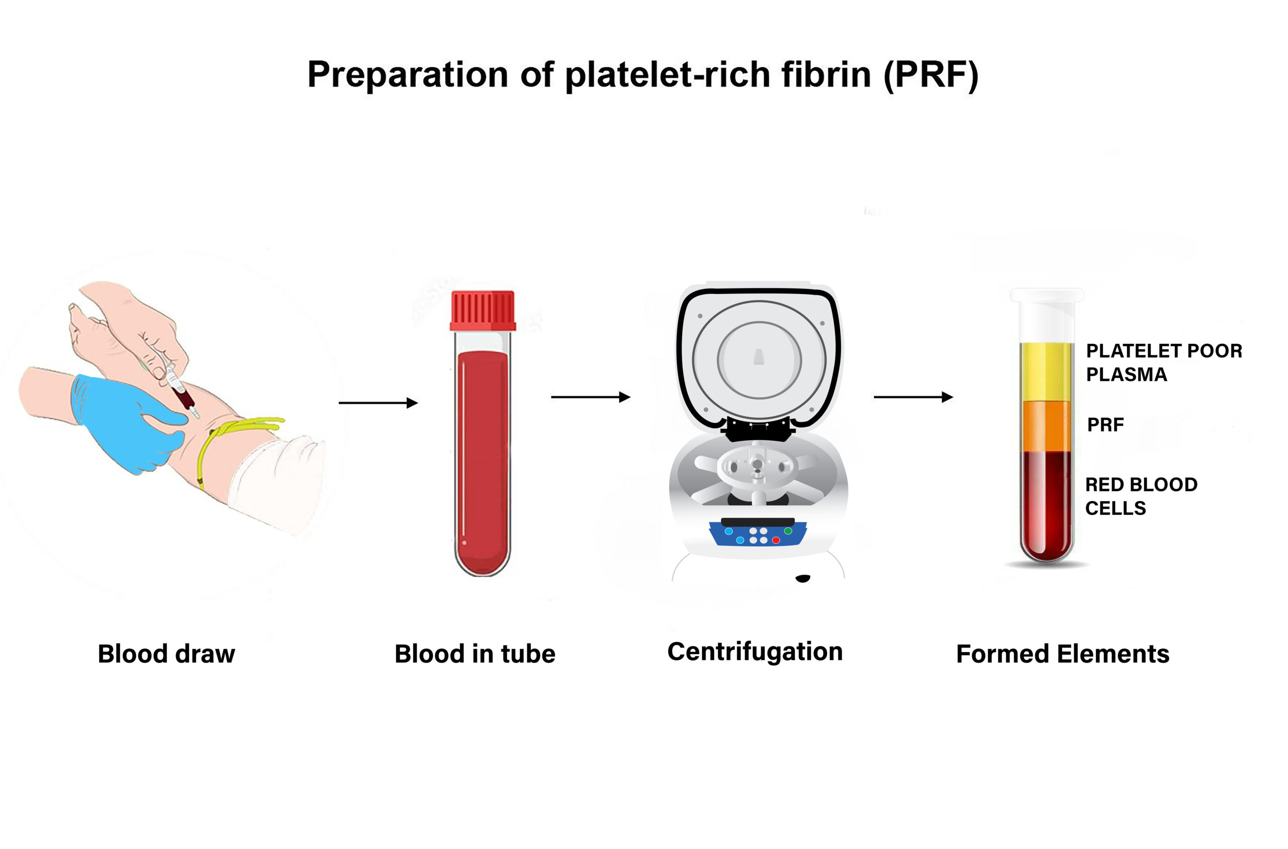 PRF Hair Treatment: Natural Solution for Hair Loss