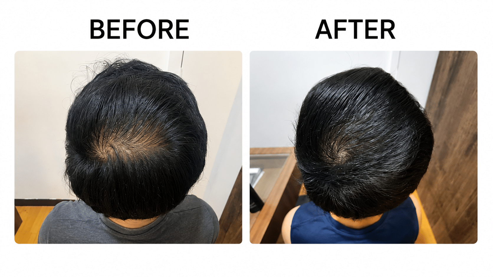 Is PRP Treatment Effective for Hair Loss? 1 PRP before and after