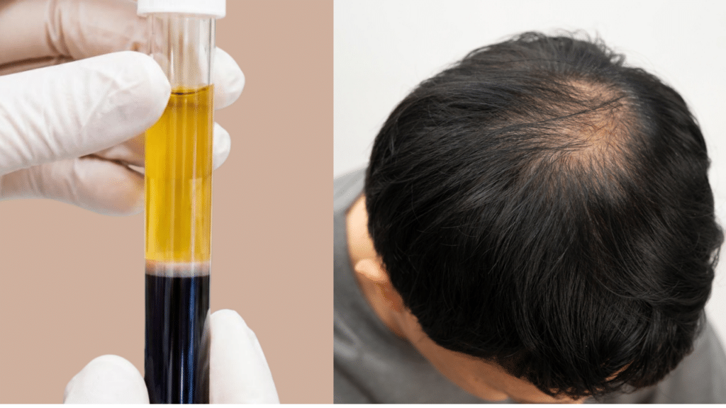 Is PRP Treatment Effective for Hair Loss? 1 PRP Tube next to a image of a balding man