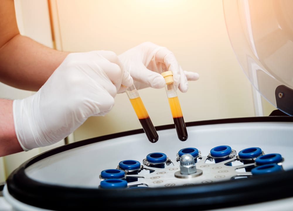 Is PRP Treatment Effective for Hair Loss? 6 PRP preparation using centrifuge spin