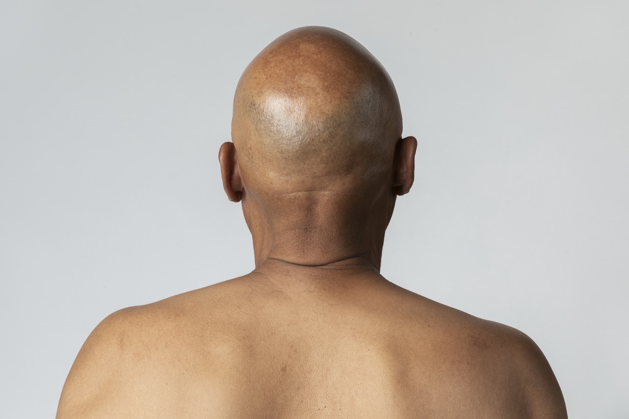 Is PRP Treatment Effective for Hair Loss? 4 The back of a bald man