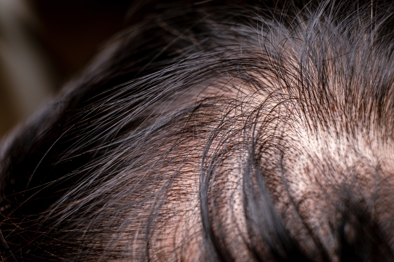 Is PRP Treatment Effective for Hair Loss? 3 hair thinning