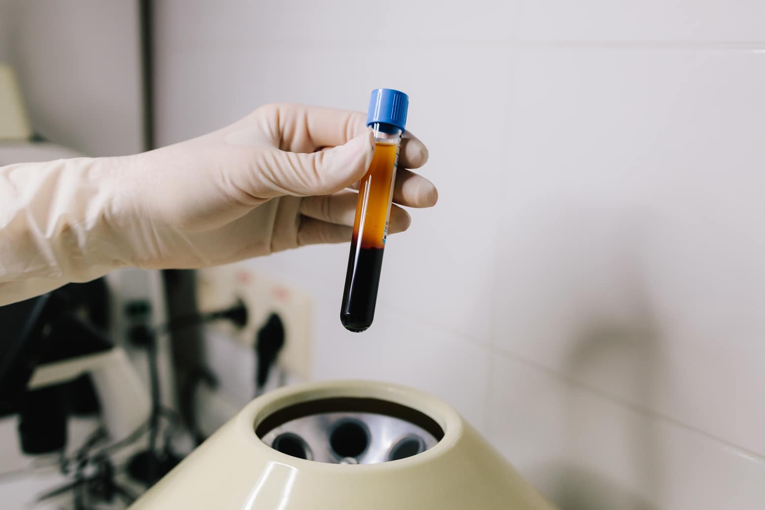 Is PRP Treatment Effective for Hair Loss? 2 prp tube blue cap being held over centrifuge