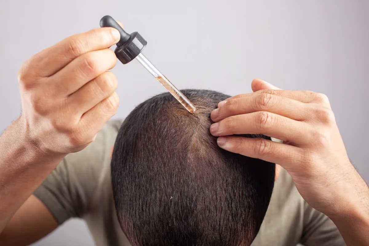 Is PRP Treatment Effective for Hair Loss? 5 minoxidil drops